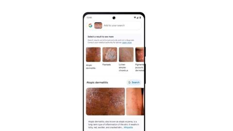 المساعدة في تشخيص الأمراض الجلدية google lens